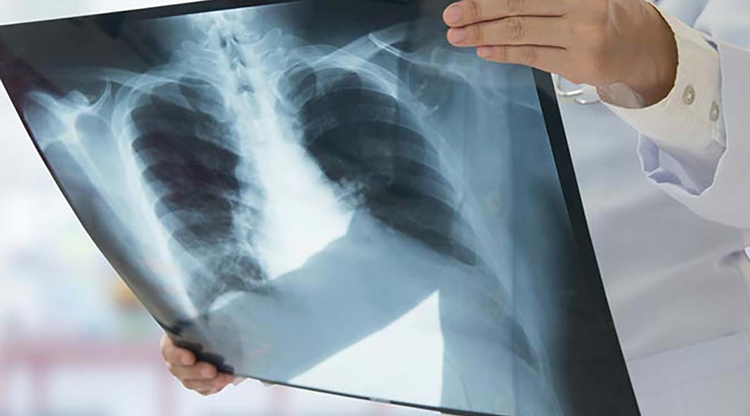 ¿Qué cuidados deben tener los pacientes recuperados de coronavirus?