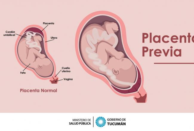 ¿cuáles Son Las Causas Y Los Síntomas De La Placenta Previa En El Embarazo Comunicación Tucumán